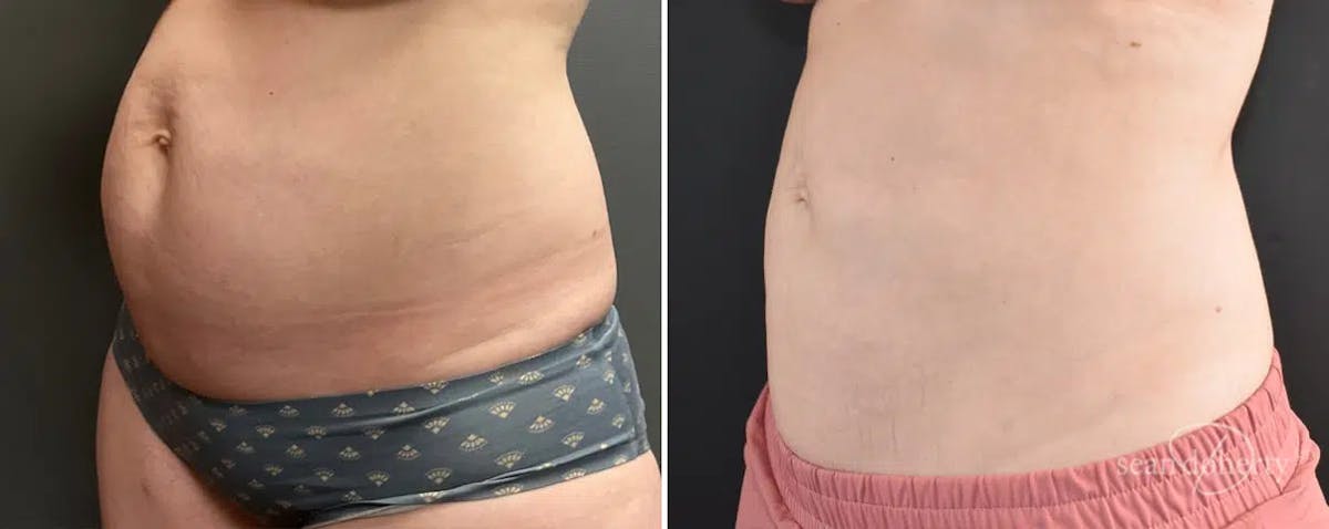 Liposuction Before & After Gallery - Patient 363043 - Image 2