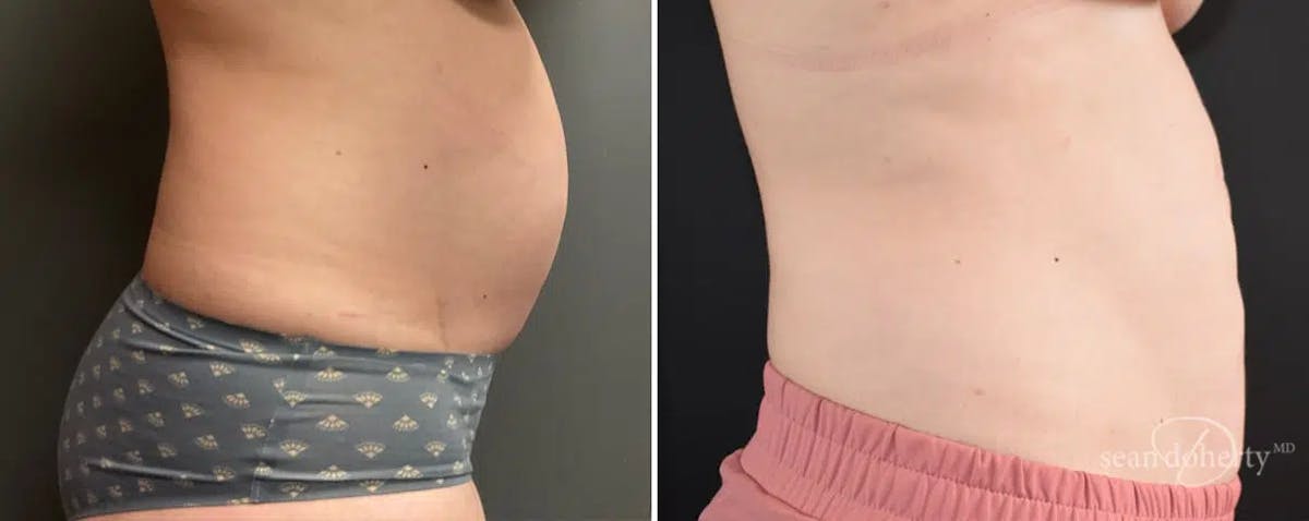 Liposuction Before & After Gallery - Patient 363043 - Image 3