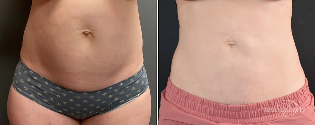 Liposuction Before & After Gallery - Patient 363043 - Image 1
