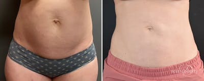 Liposuction Before & After Gallery - Patient 363043 - Image 1