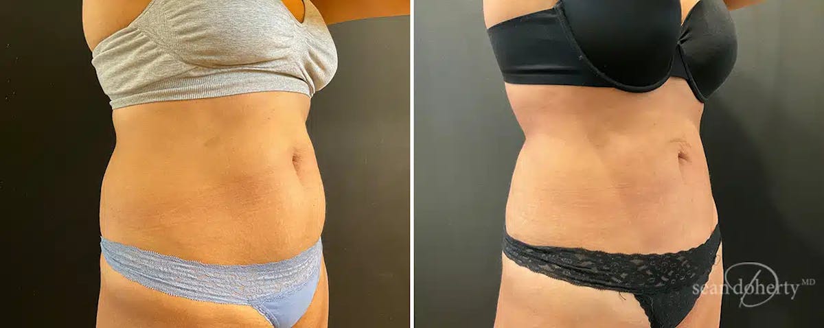 Liposuction Before & After Gallery - Patient 230093 - Image 2