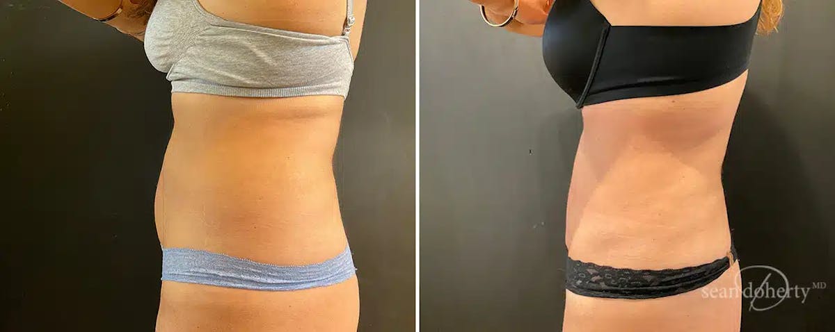 Liposuction Before & After Gallery - Patient 230093 - Image 3