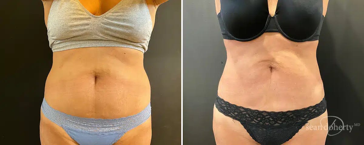 Liposuction Before & After Gallery - Patient 230093 - Image 1