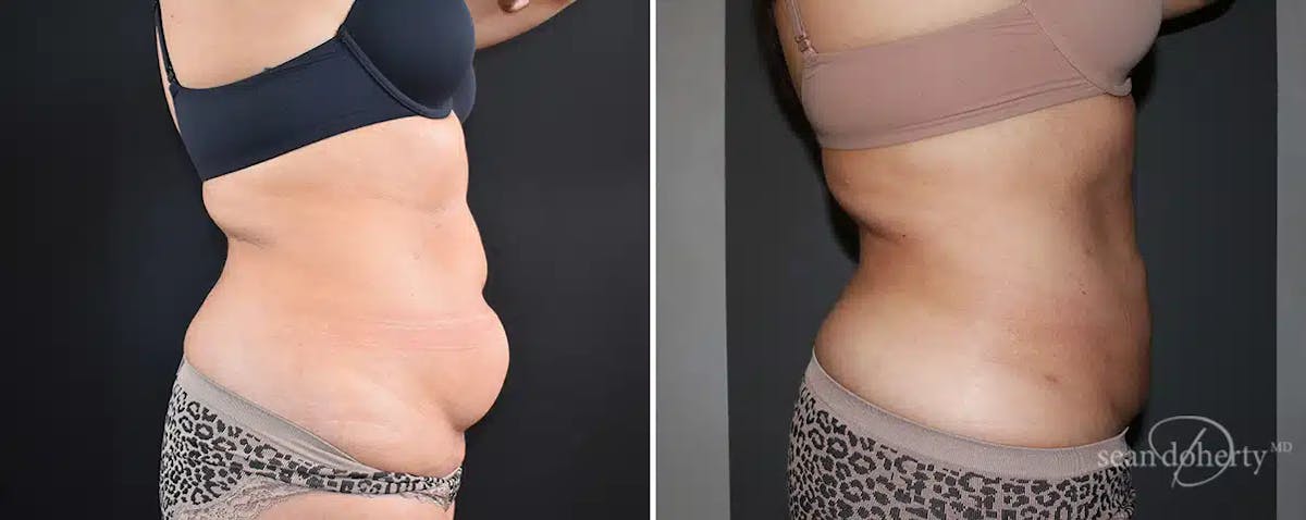 Liposuction Before & After Gallery - Patient 344917 - Image 3