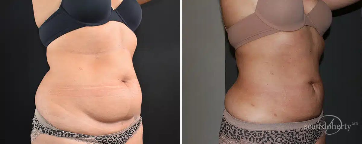 Liposuction Before & After Gallery - Patient 344917 - Image 2