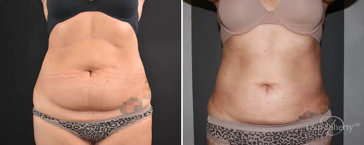 Liposuction Before & After Gallery - Patient 344917 - Image 1