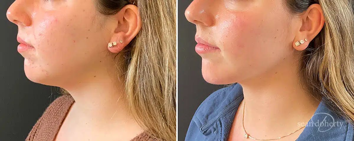 Liposuction Before & After Gallery - Patient 164488 - Image 2