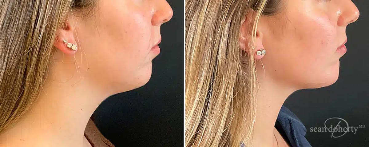 Liposuction Before & After Gallery - Patient 164488 - Image 1