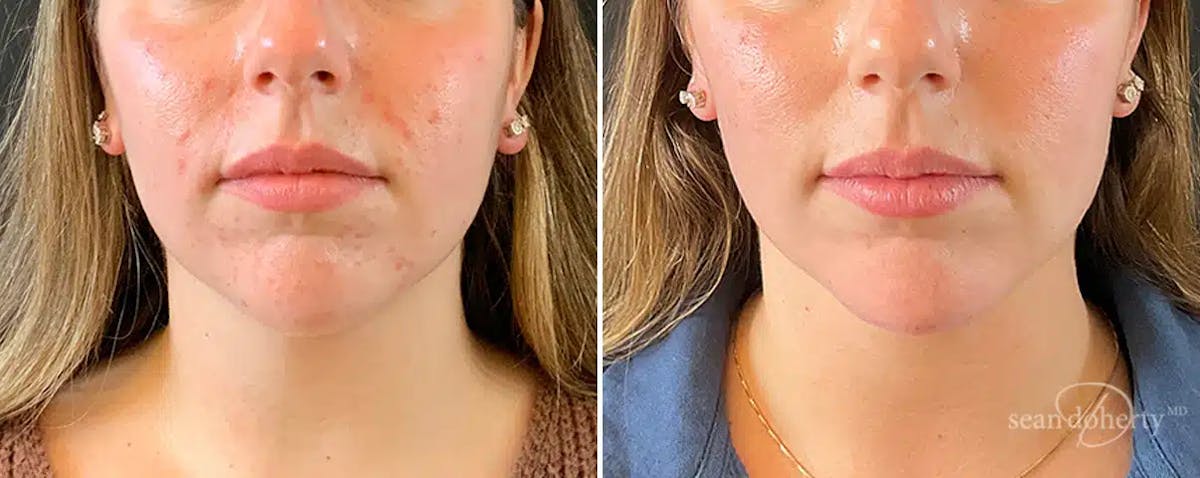 Liposuction Before & After Gallery - Patient 164488 - Image 3