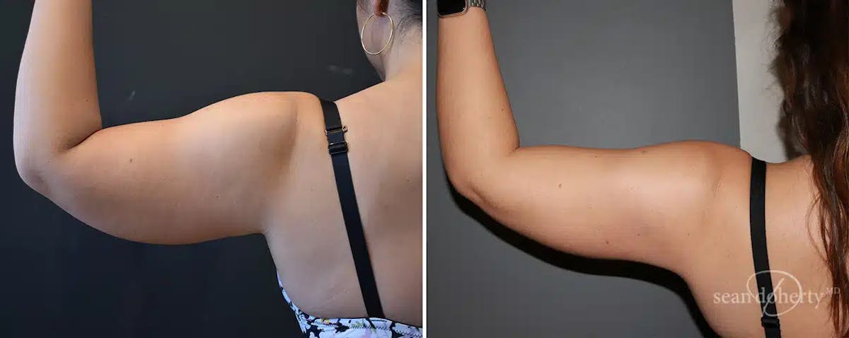 Liposuction Before & After Gallery - Patient 333510 - Image 1
