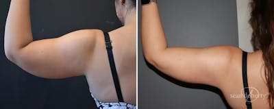 Liposuction Before & After Gallery - Patient 333510 - Image 1