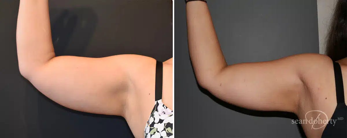 Liposuction Before & After Gallery - Patient 333510 - Image 2