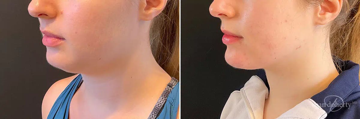 Liposuction Before & After Gallery - Patient 223325 - Image 2