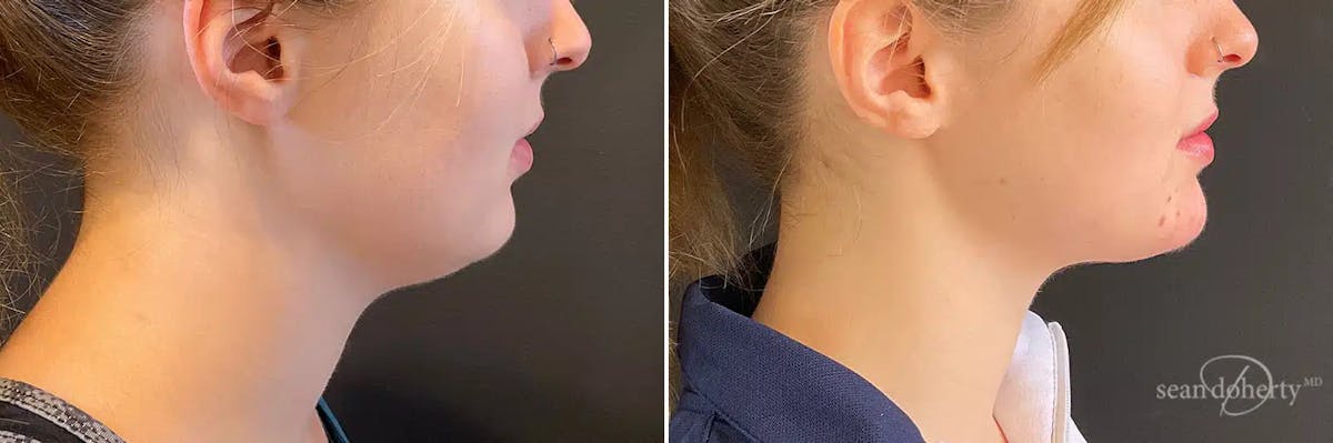 Liposuction Before & After Gallery - Patient 223325 - Image 1