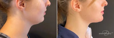 Liposuction Before & After Gallery - Patient 223325 - Image 1