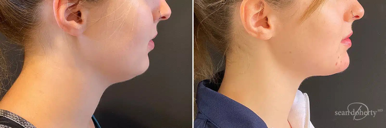 Liposuction Before & After Gallery - Patient 223325 - Image 1