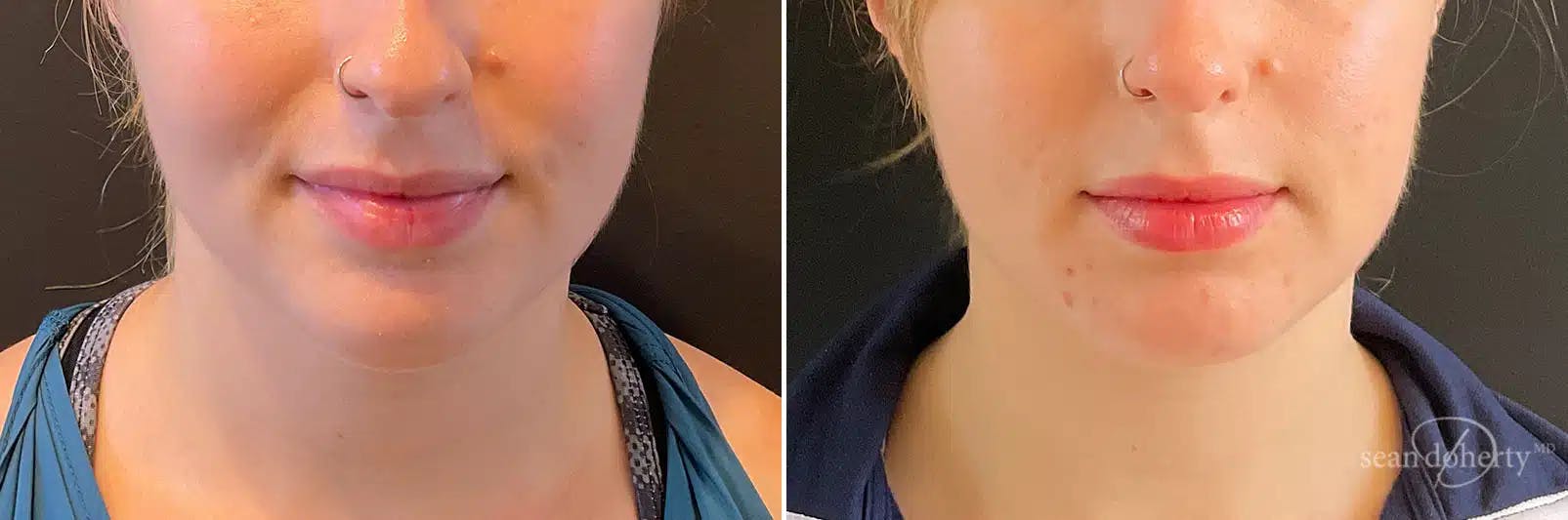 Liposuction Before & After Gallery - Patient 223325 - Image 3