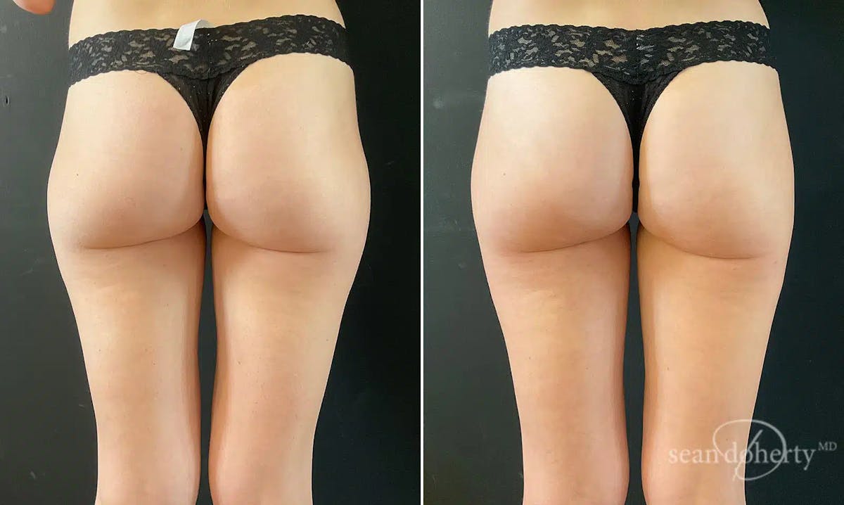 Liposuction Before & After Gallery - Patient 382255 - Image 1