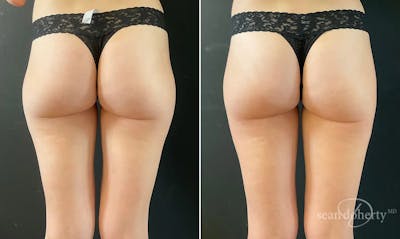 Liposuction Before & After Gallery - Patient 382255 - Image 1