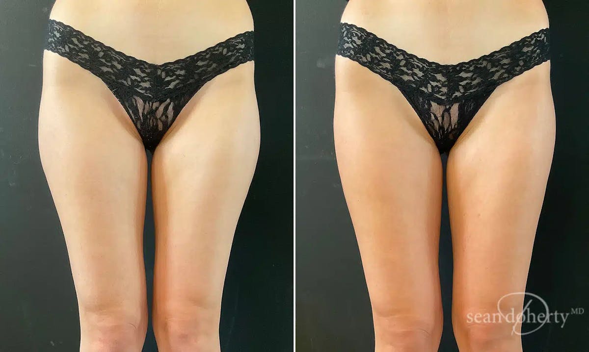 Liposuction Before & After Gallery - Patient 382255 - Image 2