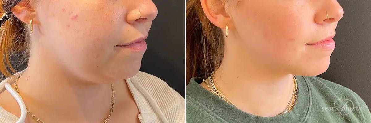 Liposuction Before & After Gallery - Patient 688411 - Image 2