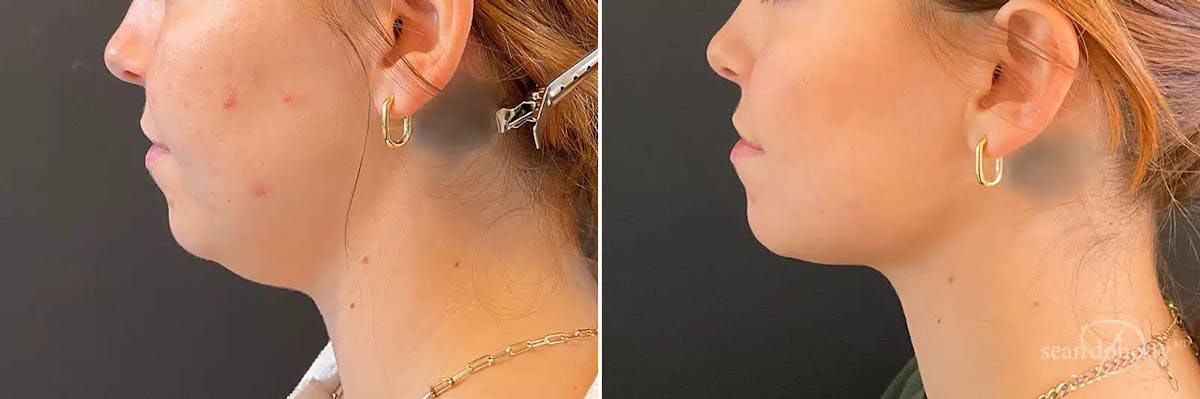 Liposuction Before & After Gallery - Patient 688411 - Image 1