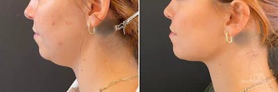 Liposuction Before & After Gallery - Patient 688411 - Image 1