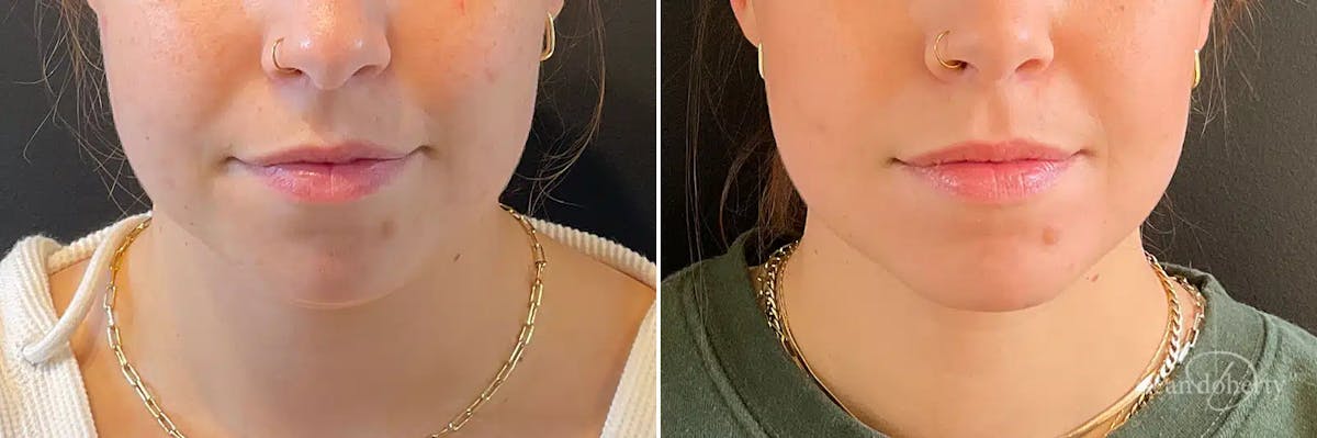 Liposuction Before & After Gallery - Patient 688411 - Image 3