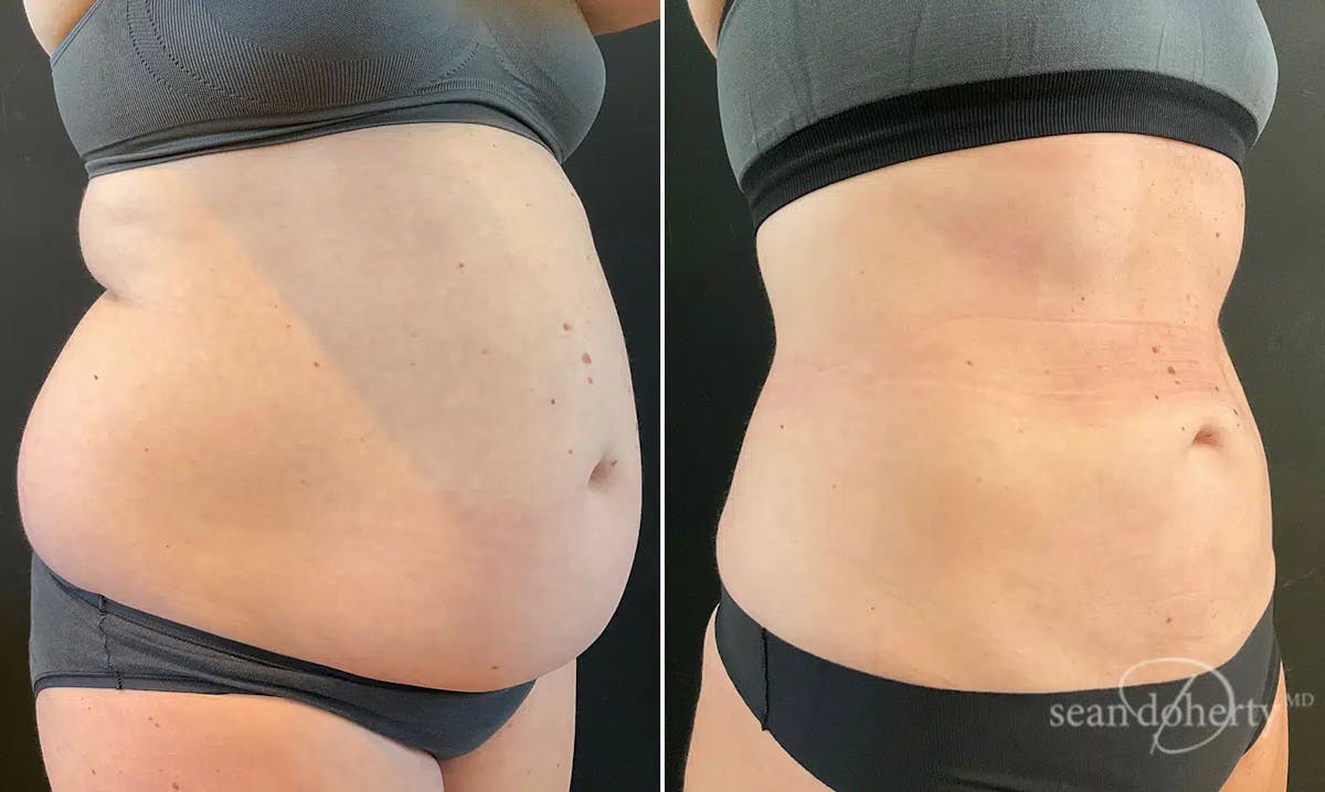 Liposuction Before & After Gallery - Patient 381223 - Image 2
