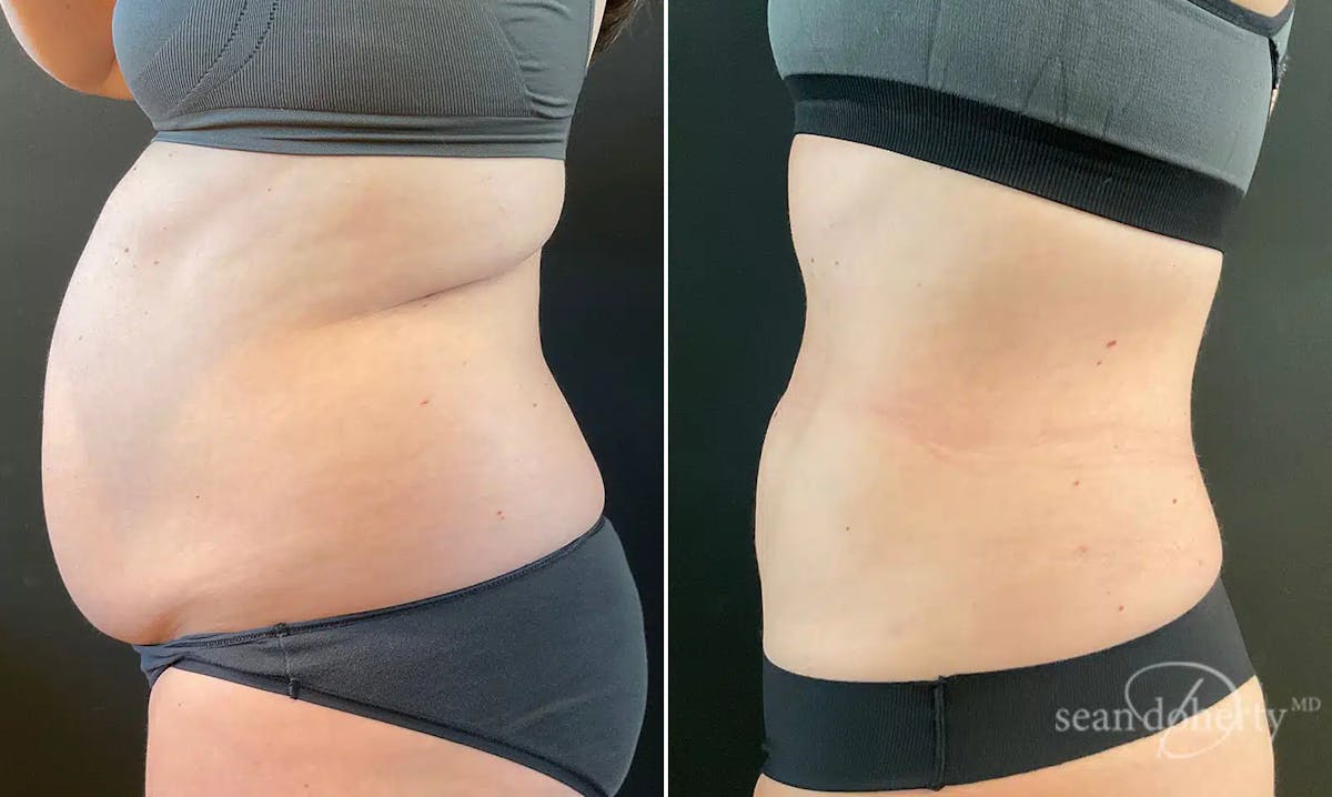 Liposuction Before & After Gallery - Patient 381223 - Image 3