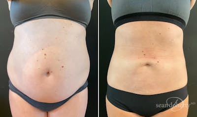 Liposuction Before & After Gallery - Patient 381223 - Image 1