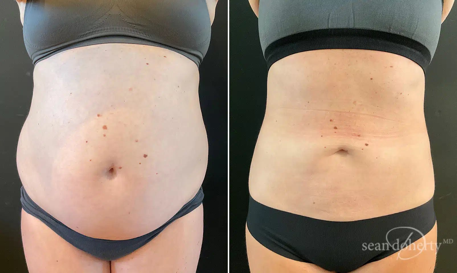 Liposuction Before & After Gallery - Patient 381223 - Image 1