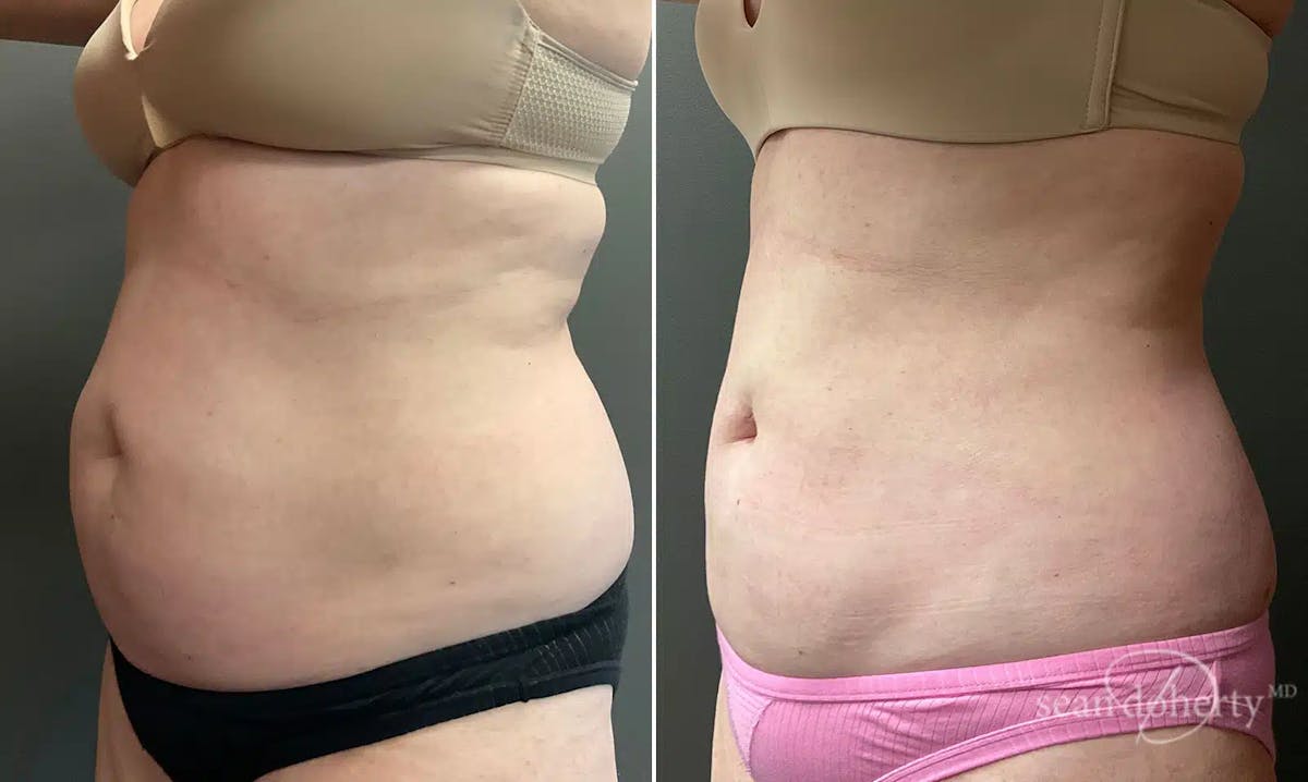 Liposuction Before & After Gallery - Patient 307135 - Image 2