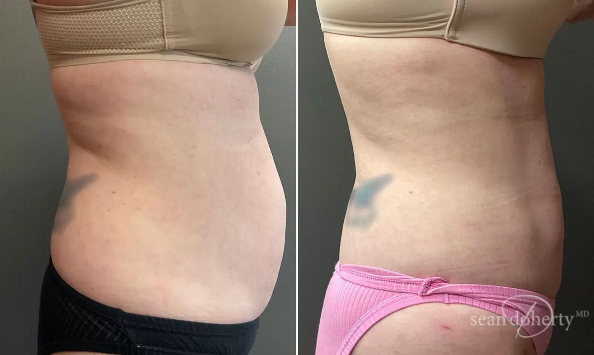 Liposuction Before & After Gallery - Patient 307135 - Image 3