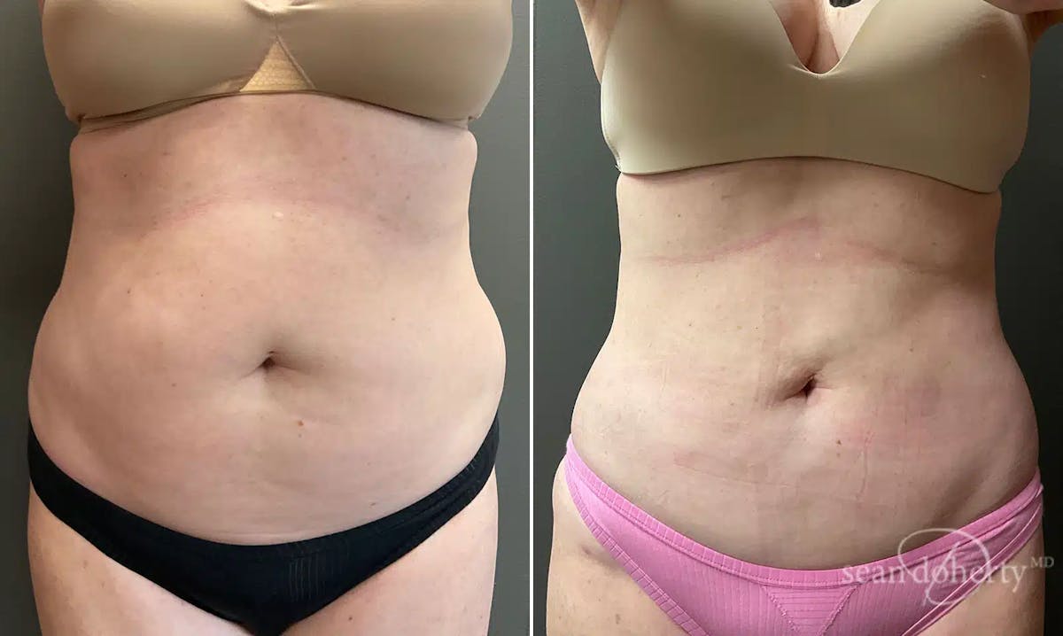 Liposuction Before & After Gallery - Patient 307135 - Image 1