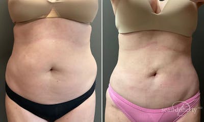 Liposuction Before & After Gallery - Patient 307135 - Image 1