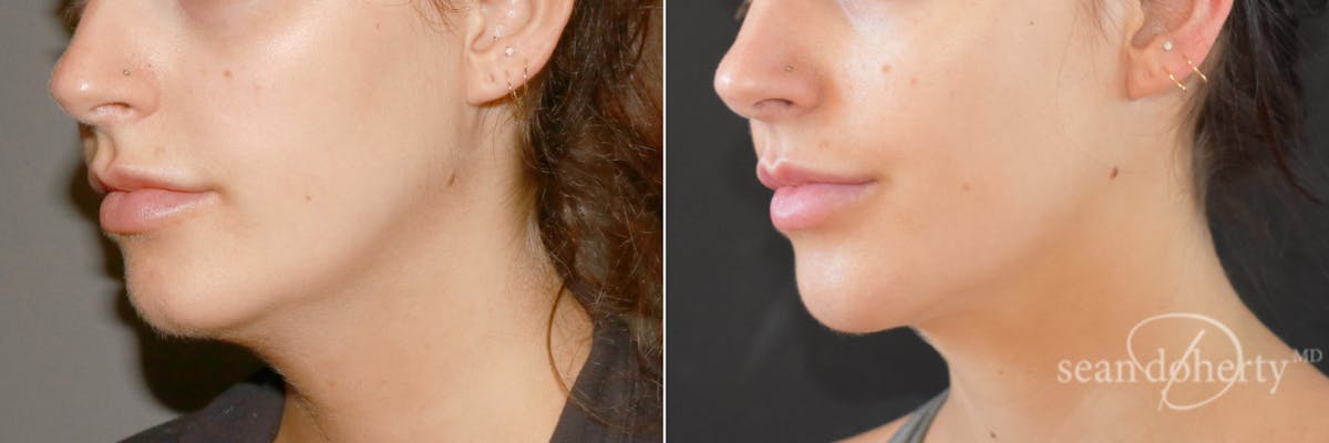 Liposuction Before & After Gallery - Patient 359216 - Image 2