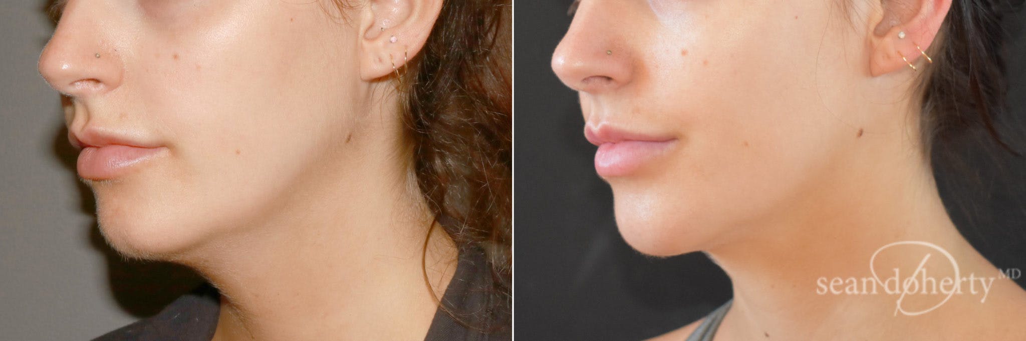 Liposuction Before & After Gallery - Patient 359216 - Image 2