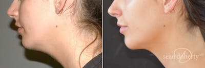 Liposuction Before & After Gallery - Patient 359216 - Image 1