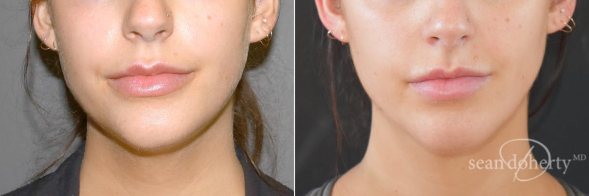 Liposuction Before & After Gallery - Patient 359216 - Image 3