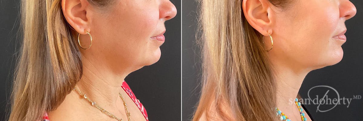 Liposuction Before & After Gallery - Patient 400515 - Image 1