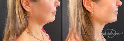 Liposuction Before & After Gallery - Patient 400515 - Image 1
