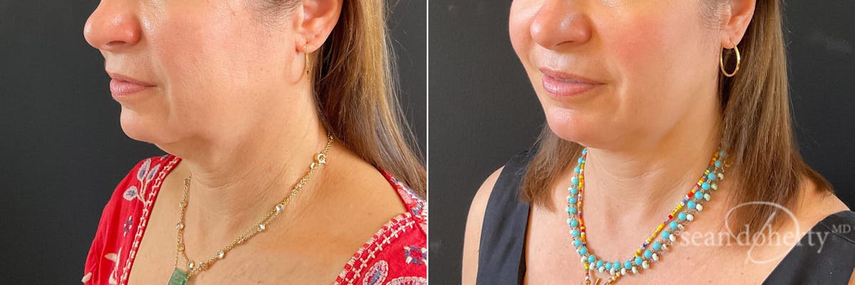 Liposuction Before & After Gallery - Patient 400515 - Image 2