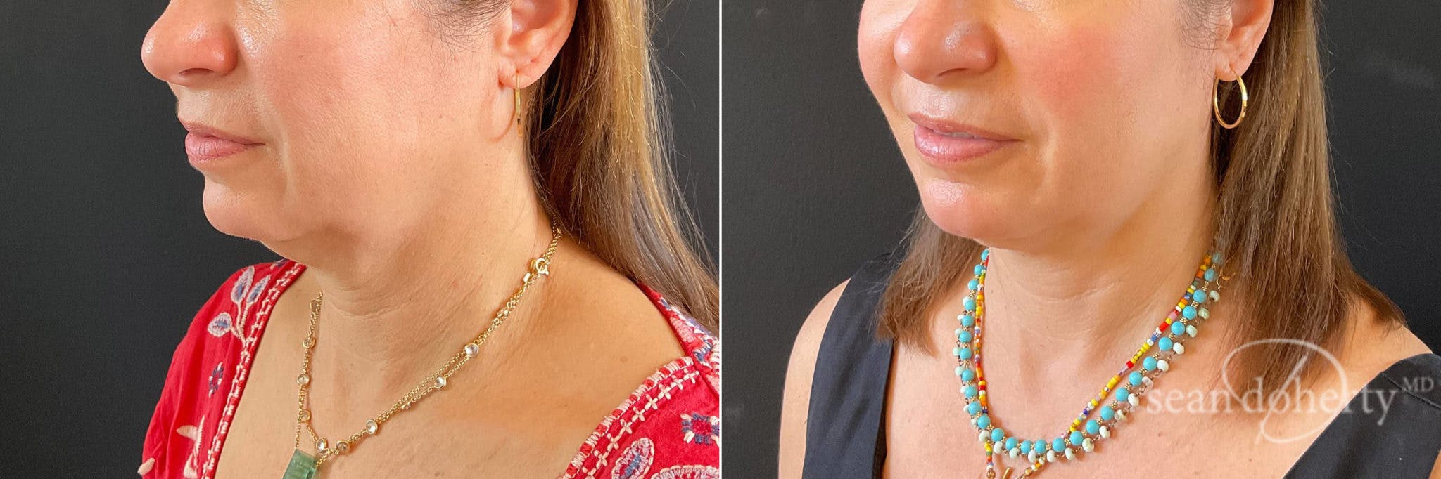 Liposuction Before & After Gallery - Patient 400515 - Image 2