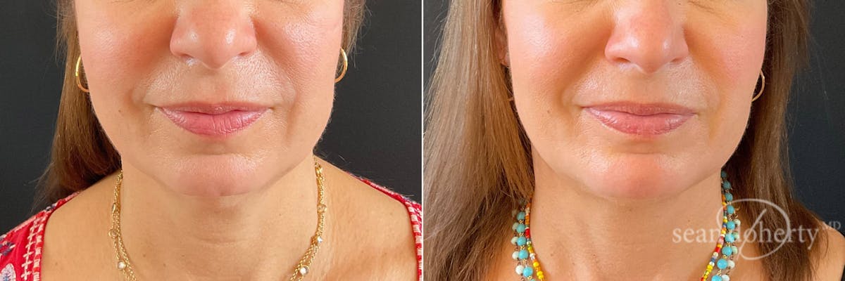 Liposuction Before & After Gallery - Patient 400515 - Image 3