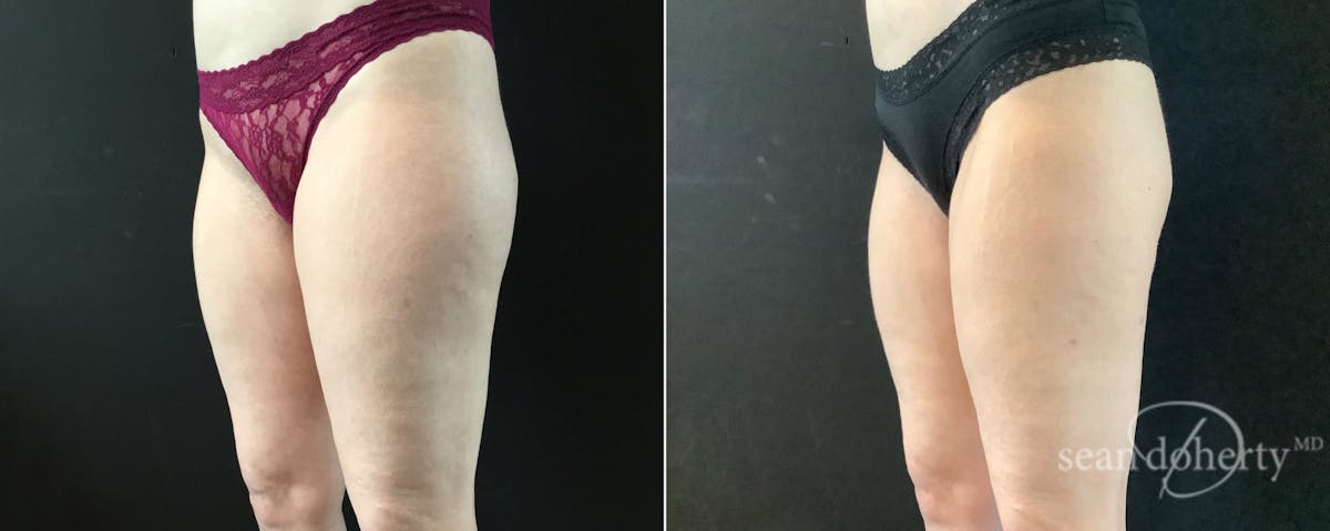 Liposuction Before & After Gallery - Patient 374650 - Image 3