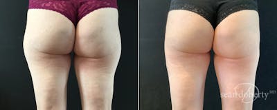 Liposuction Before & After Gallery - Patient 374650 - Image 1