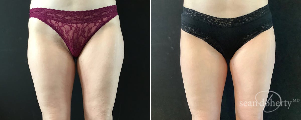 Liposuction Before & After Gallery - Patient 374650 - Image 2