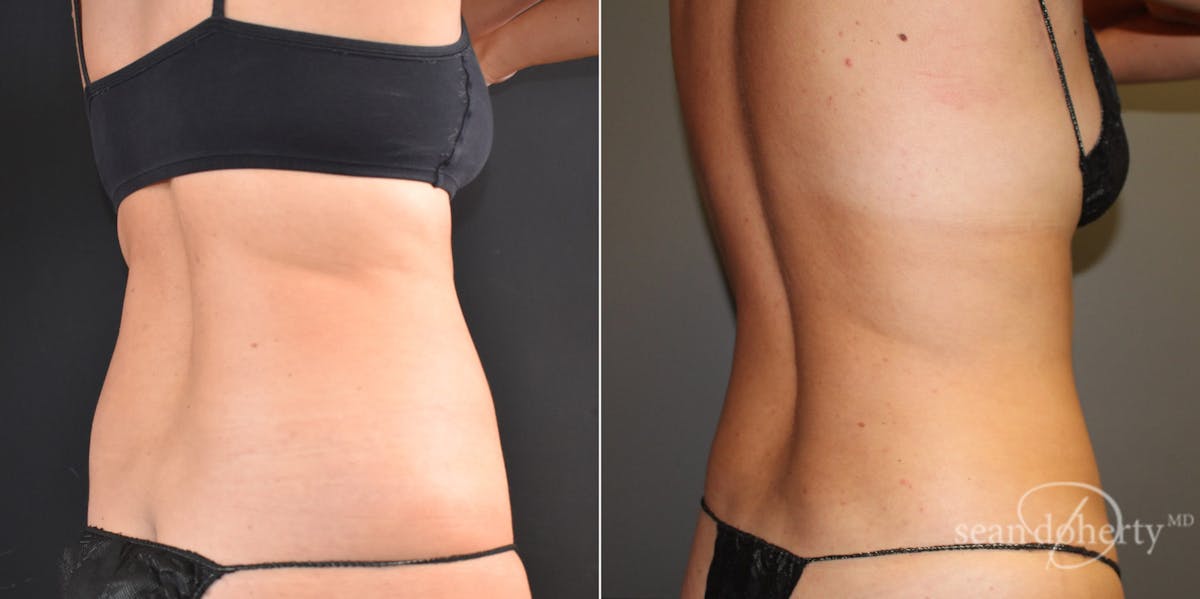 Liposuction Before & After Gallery - Patient 190428 - Image 2