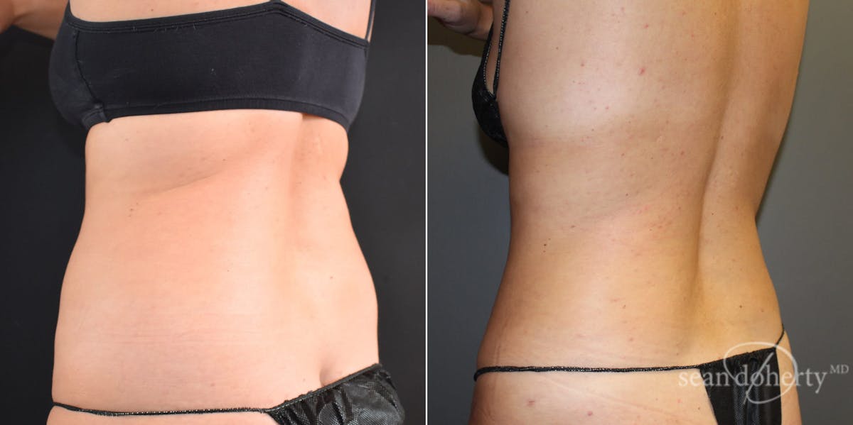 Liposuction Before & After Gallery - Patient 190428 - Image 3